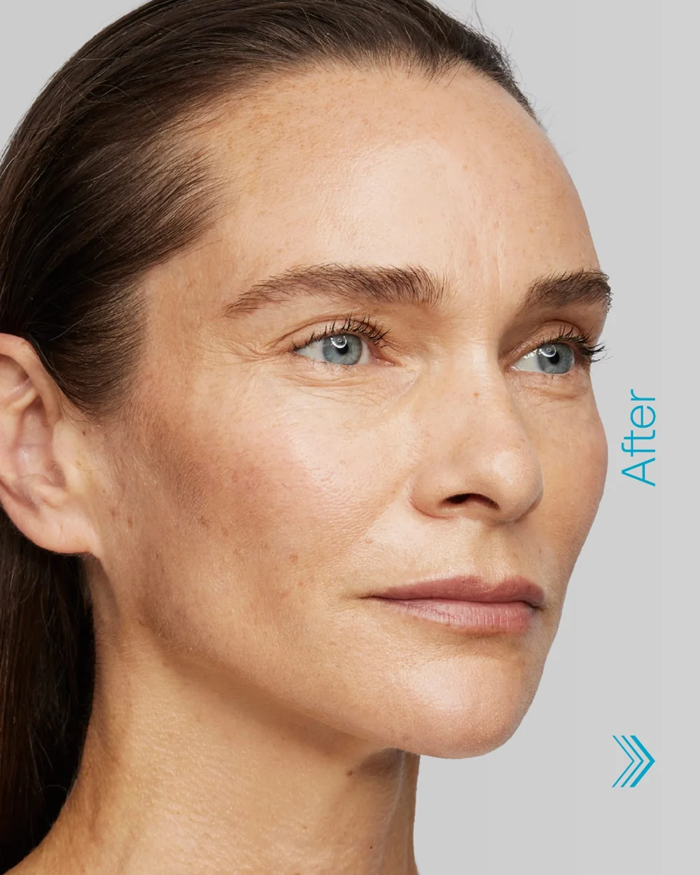 Radiesse treatment at HADA Aesthetics, Leigh-on-Sea & Essex (2)
